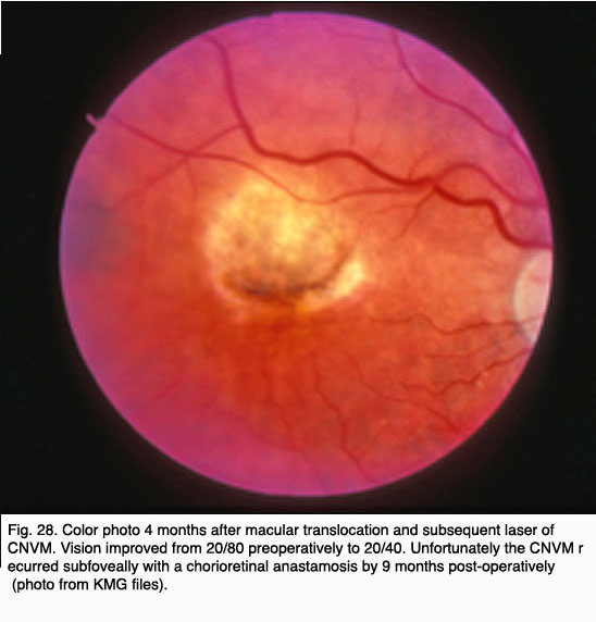 Age Related Macular Degeneration Amd By Gregory S Hageman Karen Gaehrs Lincoln V Johnson And Don Anderson Webvision