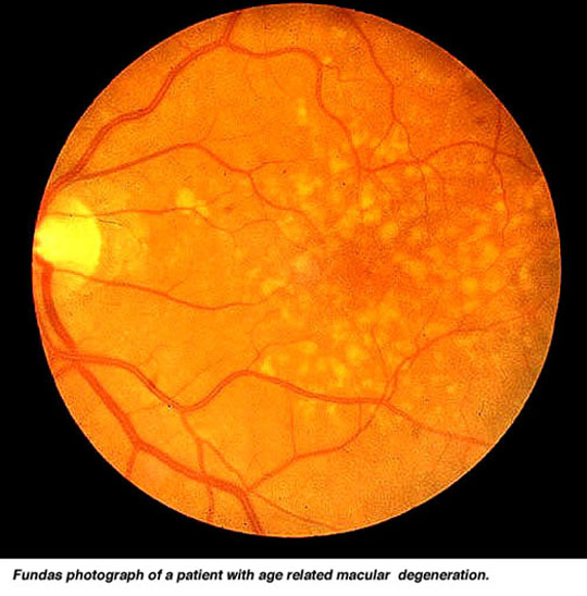 Figure 1. [The normal human retina fundus]. - Webvision - NCBI