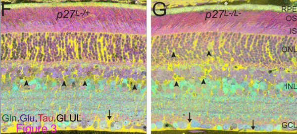 Reactive Gliosis