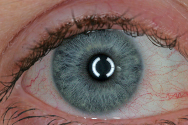 Limitations Of Iris Scans