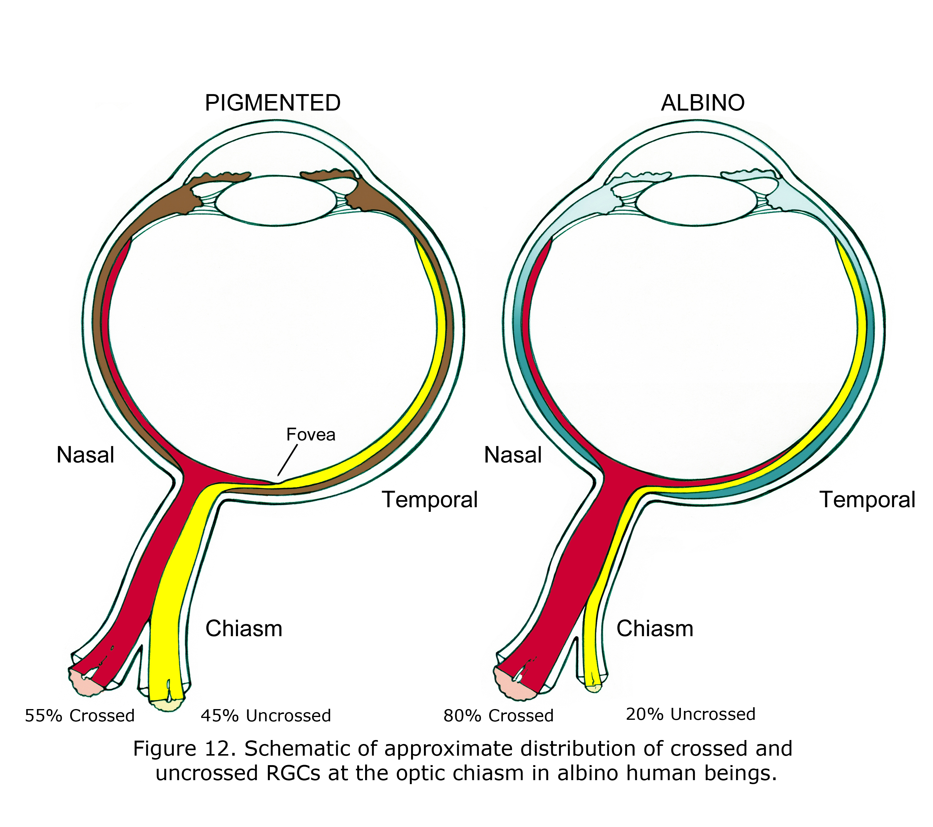 Ocular Albinism On Emaze