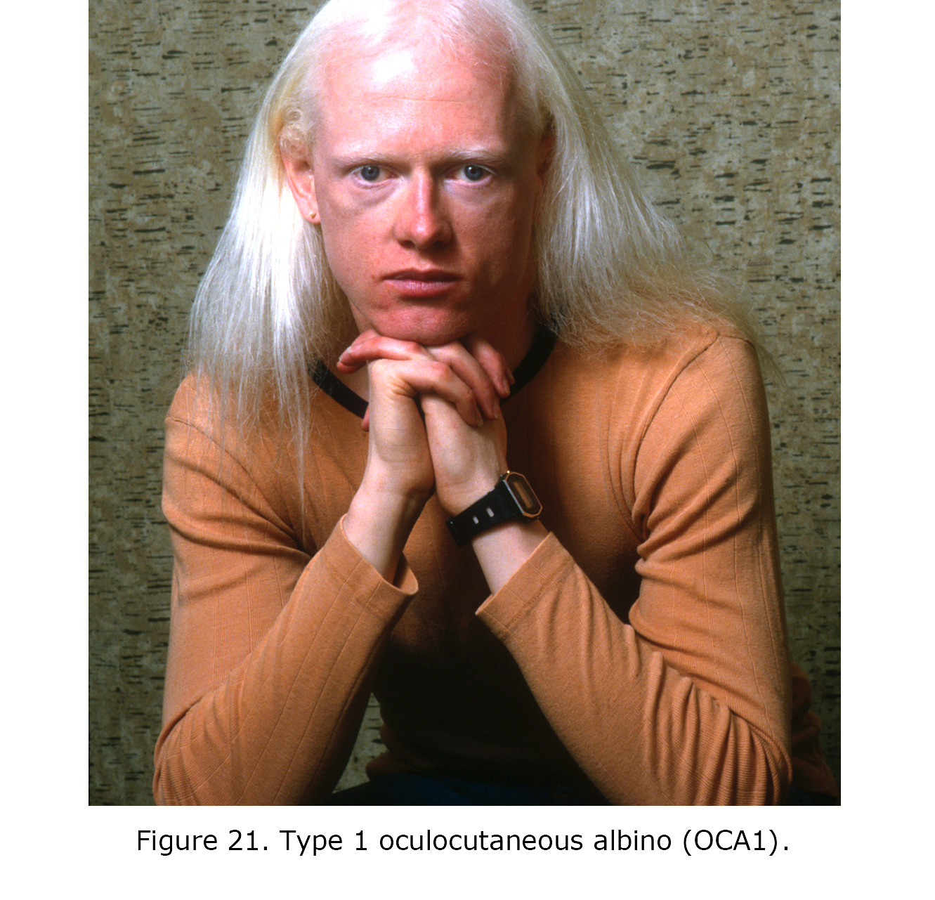 Albinism & Makeup: The Challenges of Choosing a Foundation - Albinism Up  Close