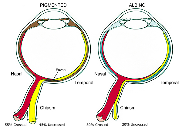 albinism eye problems