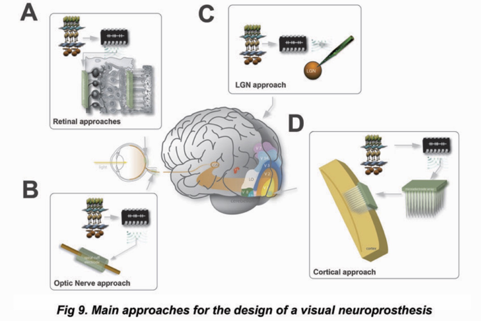 First human implantation of the WFMA for intracortical visual