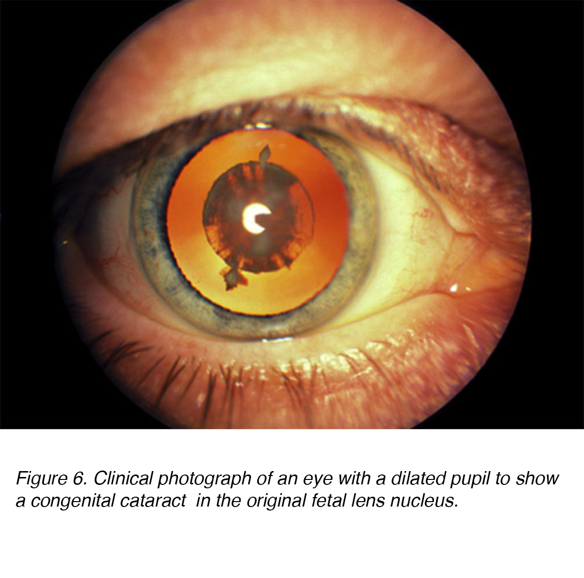 crystalline lens and cataract by joah f. aliancy and nick mamalis