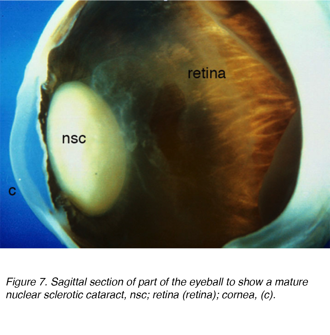 Crystalline Lens and Cataract by Joah F. Aliancy and Nick Mamalis