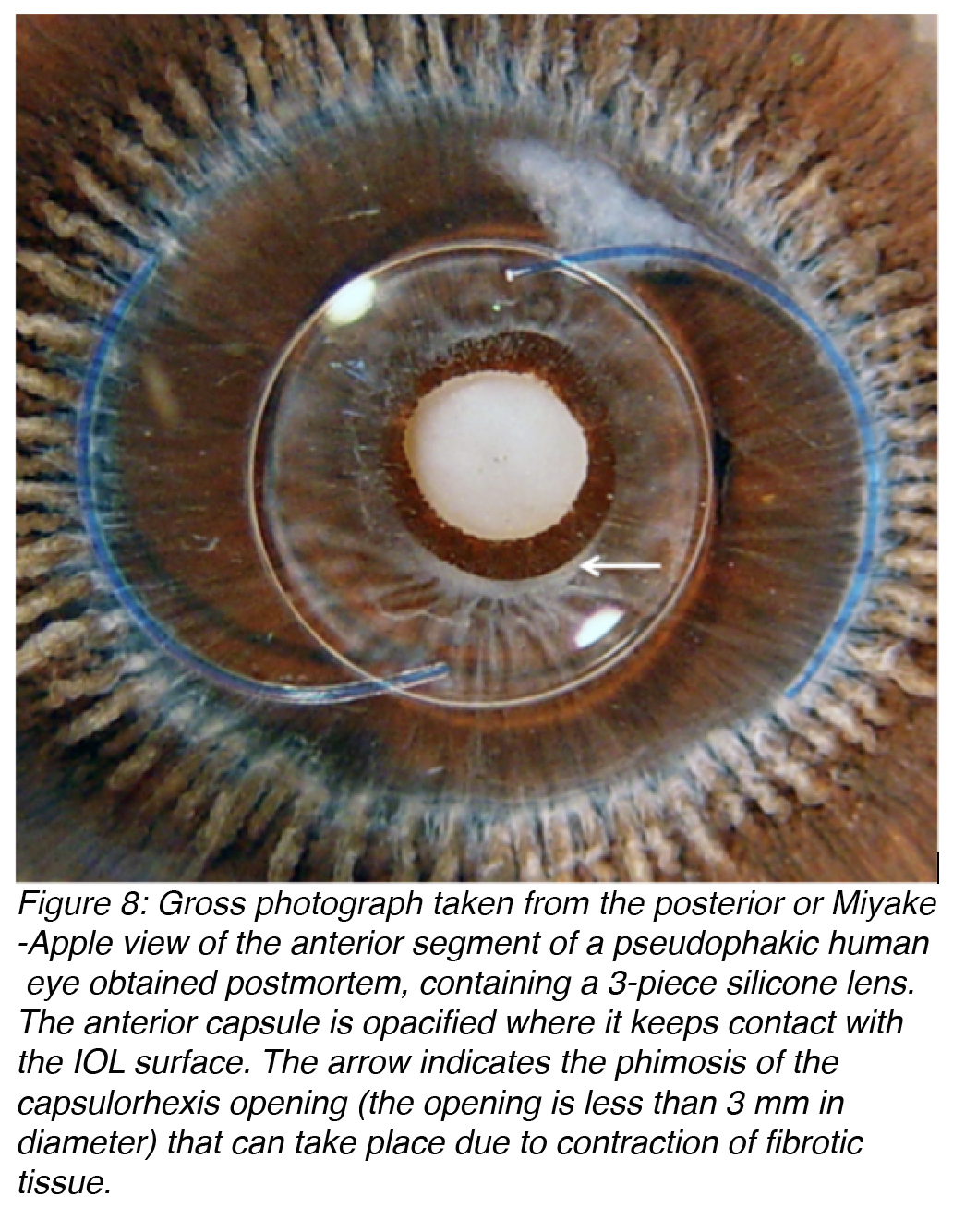 Intraocular Lenses for Cataract Surgery by Jason Nguyen and Liliana