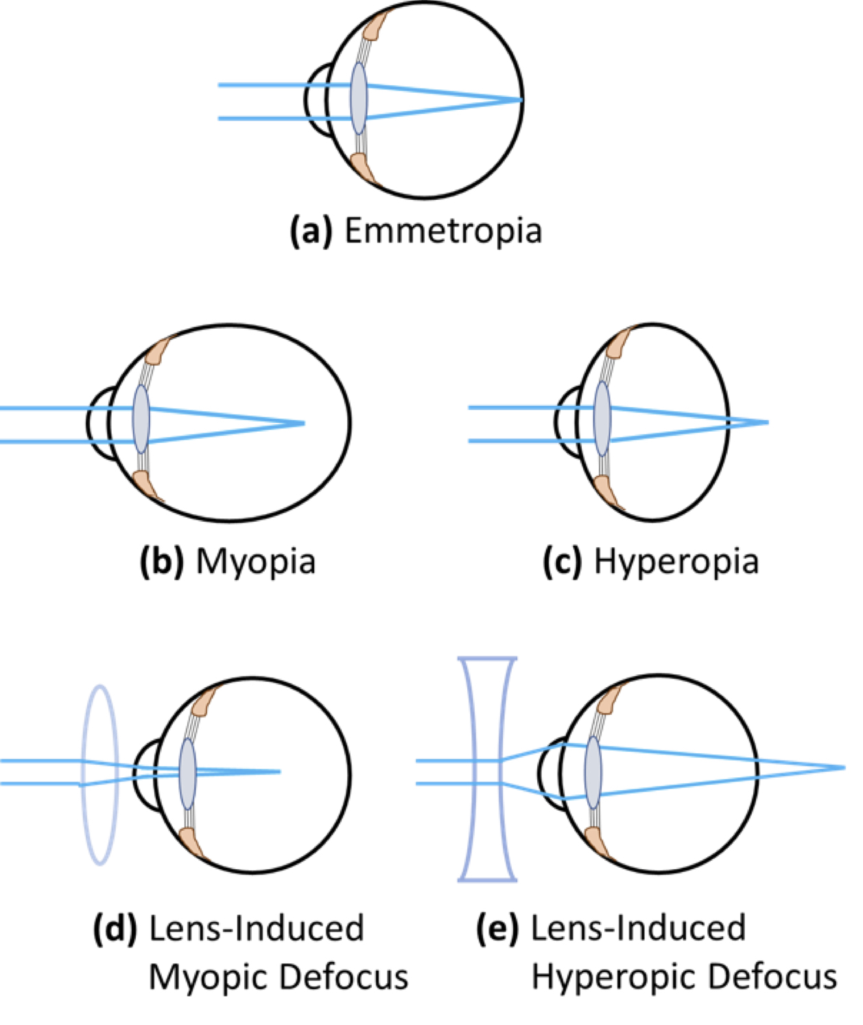 myopia vagy myopia