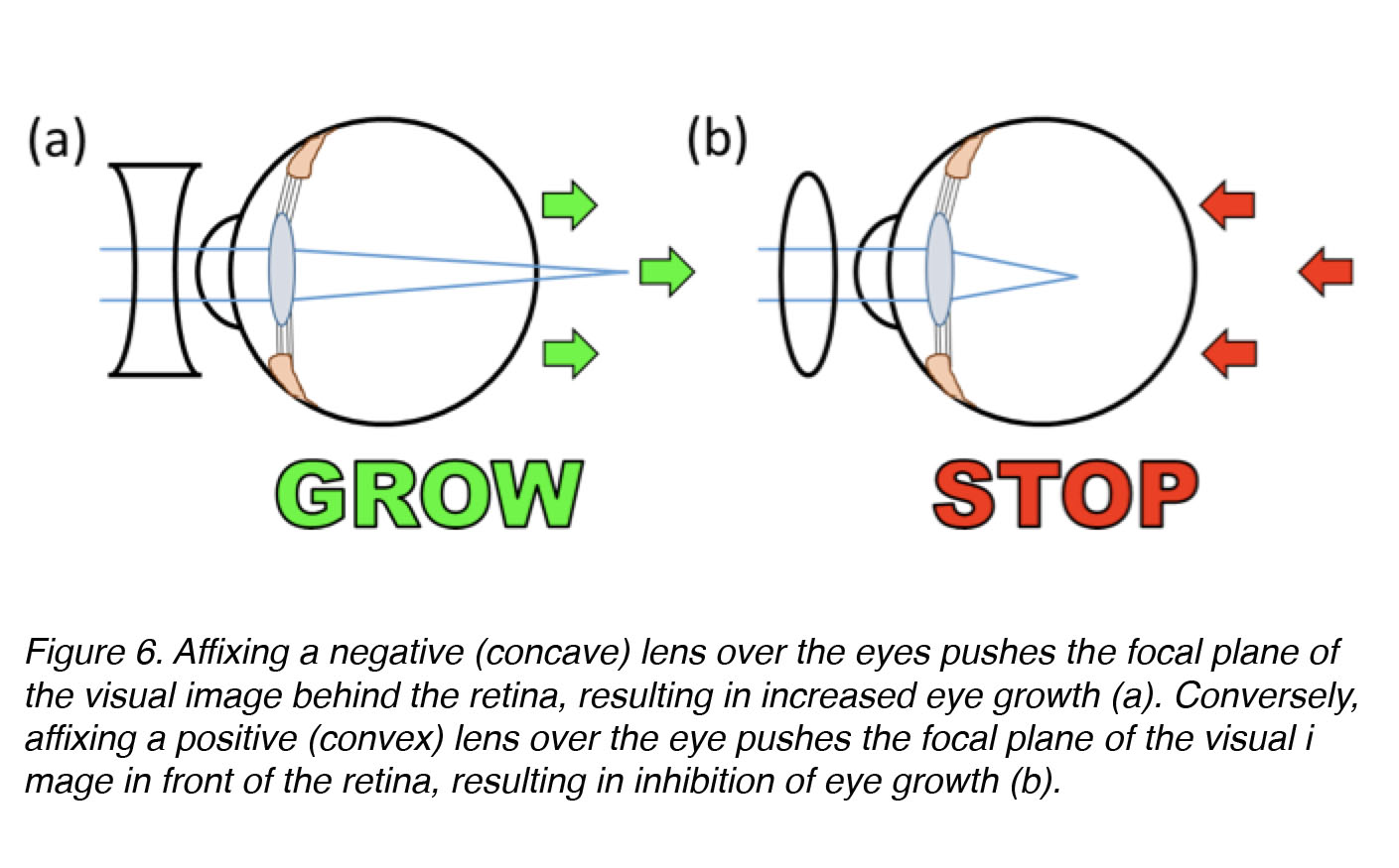 retina myopia progression látás helyreállítása 05