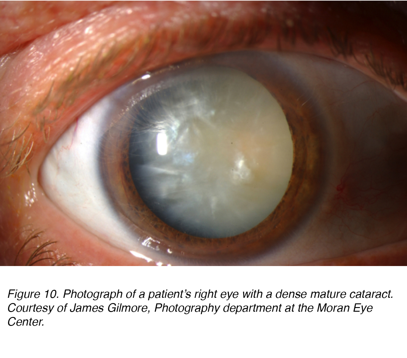 Crystalline Lens And Cataract By Joah F Aliancy And Nick Mamalis