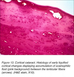 Crystalline Lens and Cataract by Joah F. Aliancy and Nick Mamalis ...