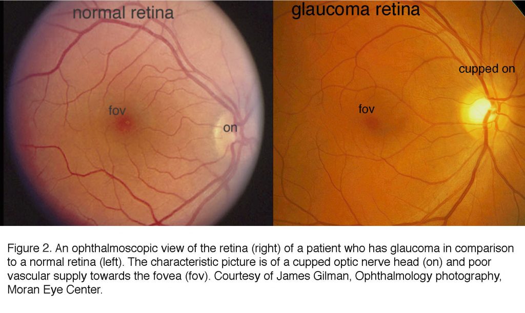 What Is Glaucoma? By David Krizaj – Webvision