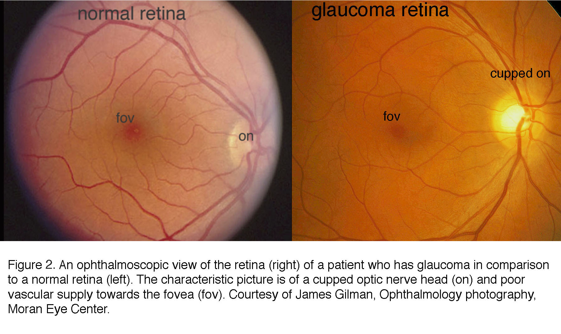 papilledema vs glaucoma