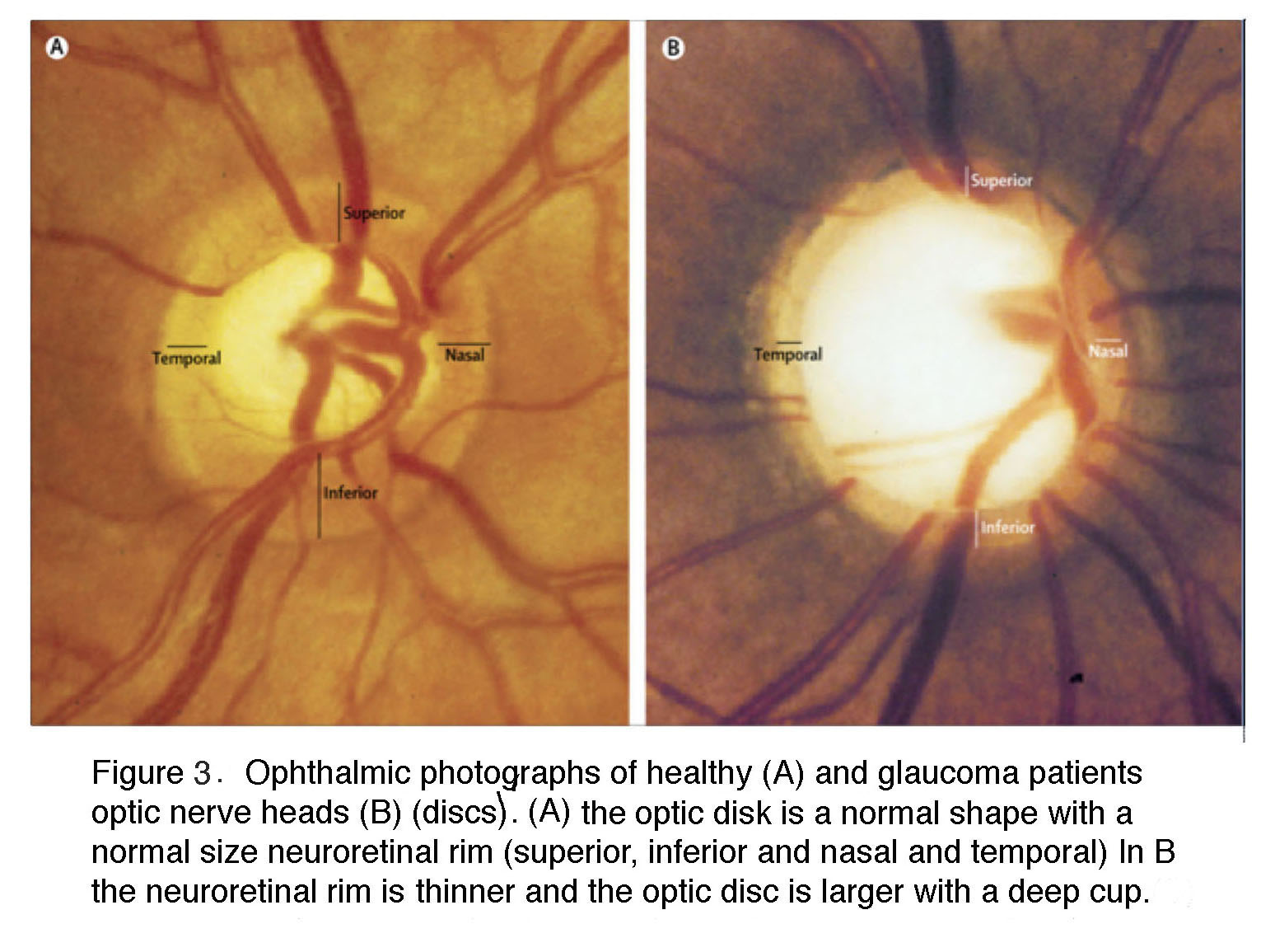 optic nerve glaucoma