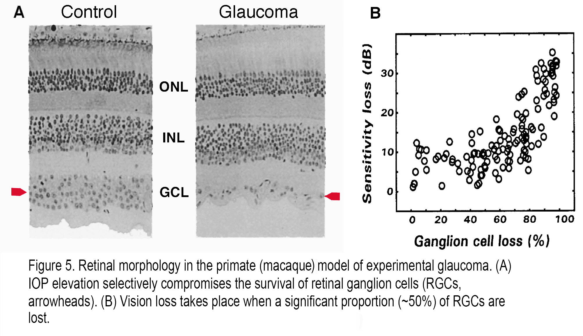 glaucoma vision loss pattern