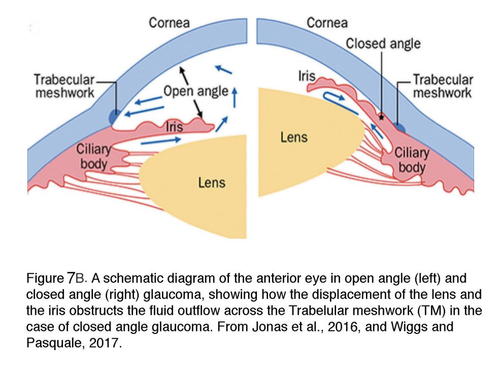 What Is Glaucoma By David Krizaj Webvision 7832