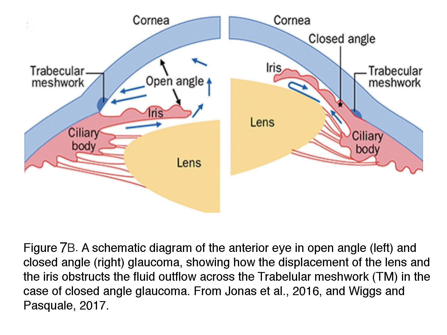 What is glaucoma? by David Krizaj – Webvision