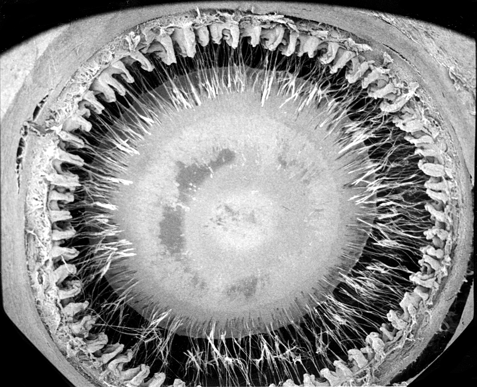 Zonular Cataract